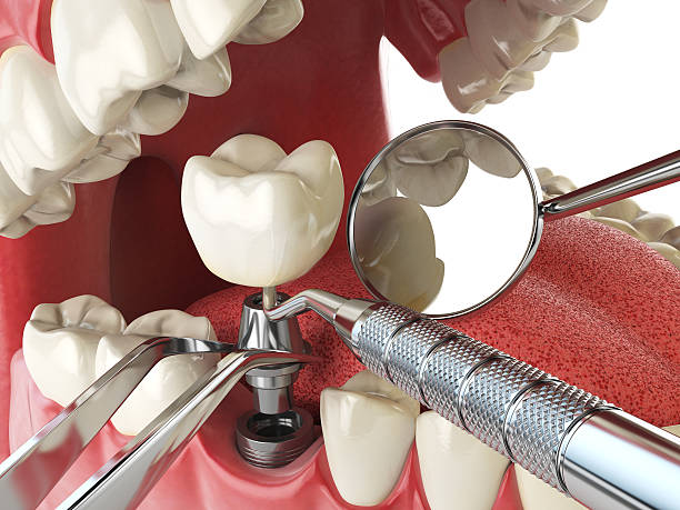 Best Knocked-Out Tooth (Avulsed Tooth) Treatment in Odell, OR